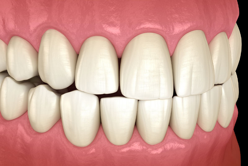 Occlusal 3d model tmj issue