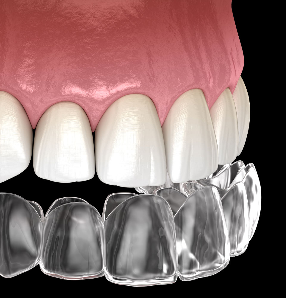 clear aligner 3d model