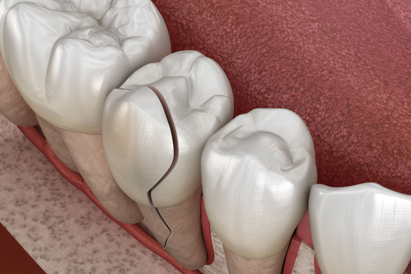 cracked tooth 3d model