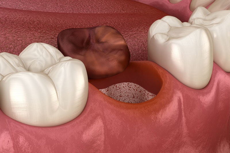 dry socket after tooth removal 3dmodel