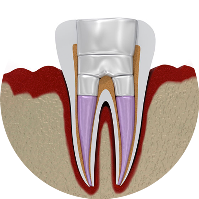 endodontic treatment 3dmodel