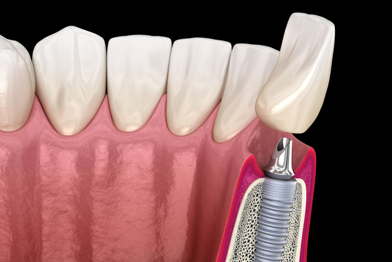 implant 3d model being placed into bone