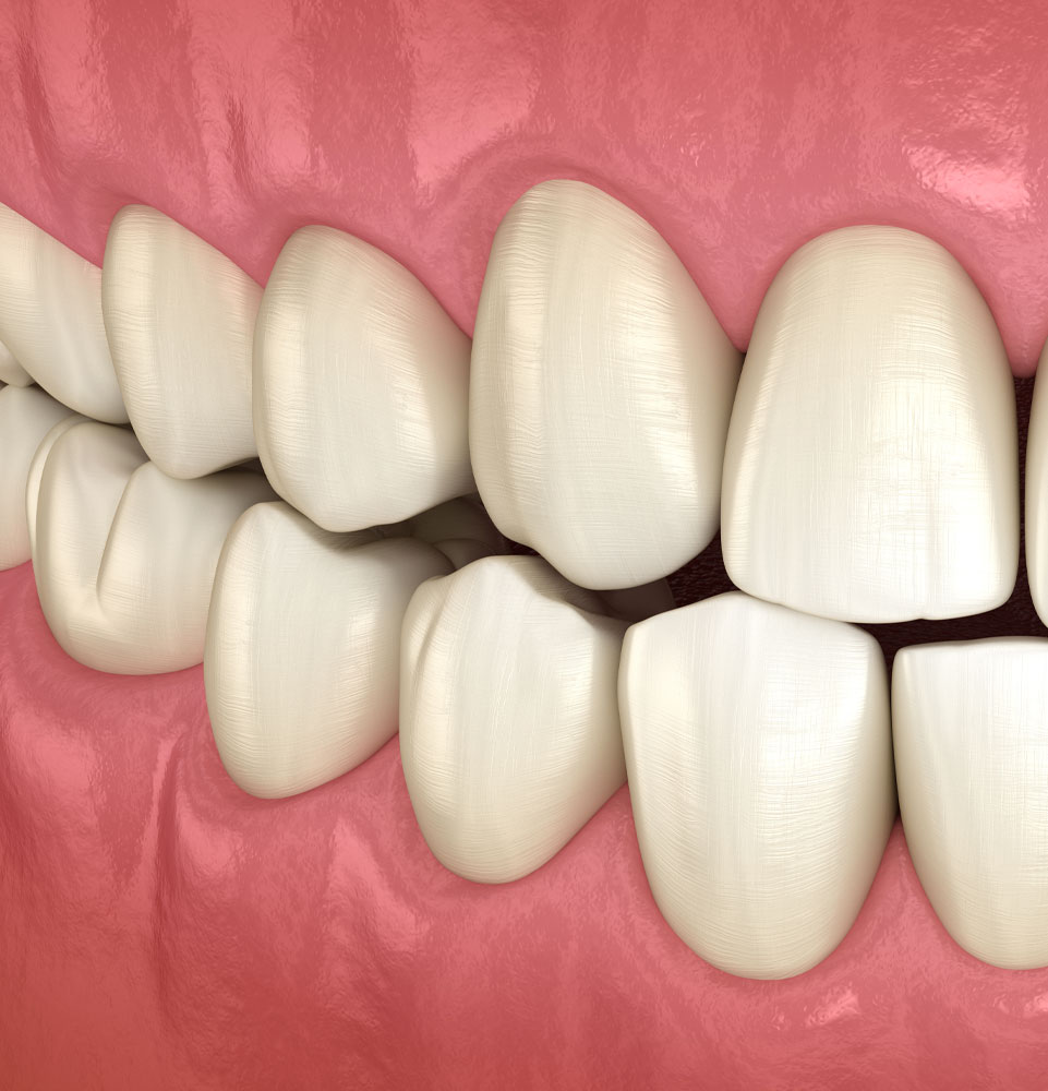 occlusal adjusment 3d model