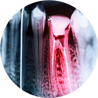 root canal xray circle