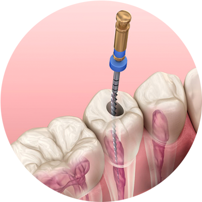 rootcanal procedure apicoectomy 3dmodel