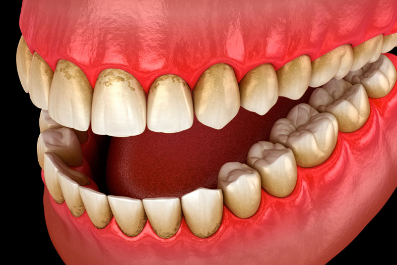 swollen gum tissue 3d model