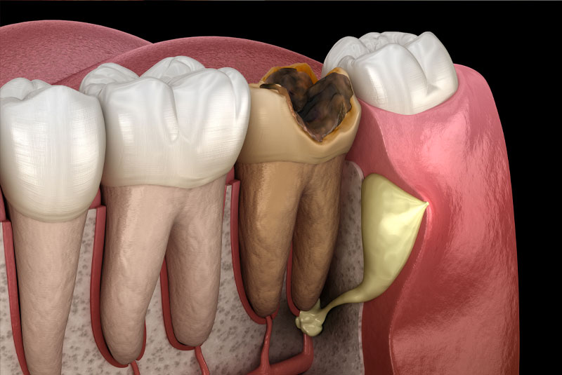 tooth abscess 3d model