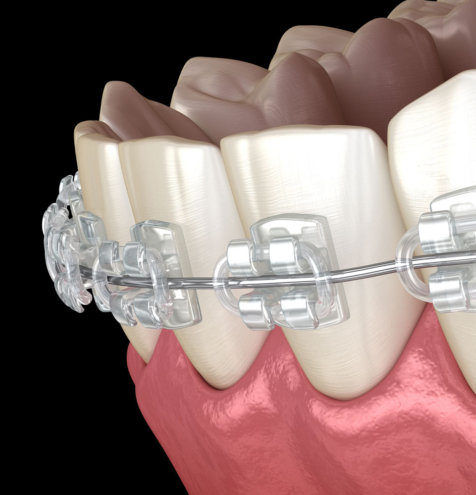 traditional braces 3d model