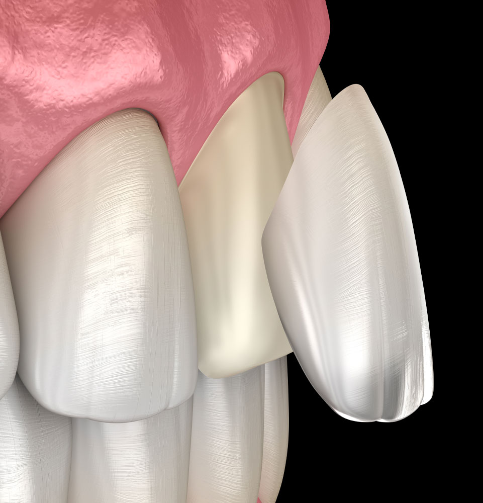 veneer 3d model