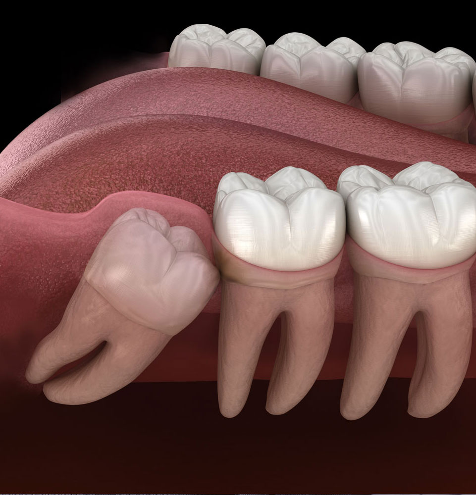 wisdom tooth 3d model coming in at angle
