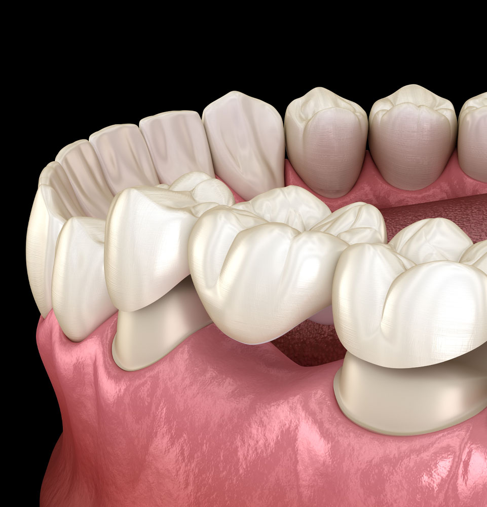dental bridges 3d model