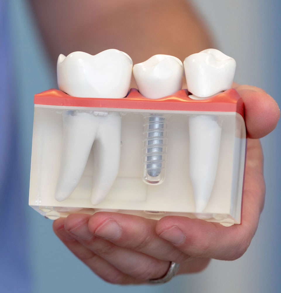dental implant model being held