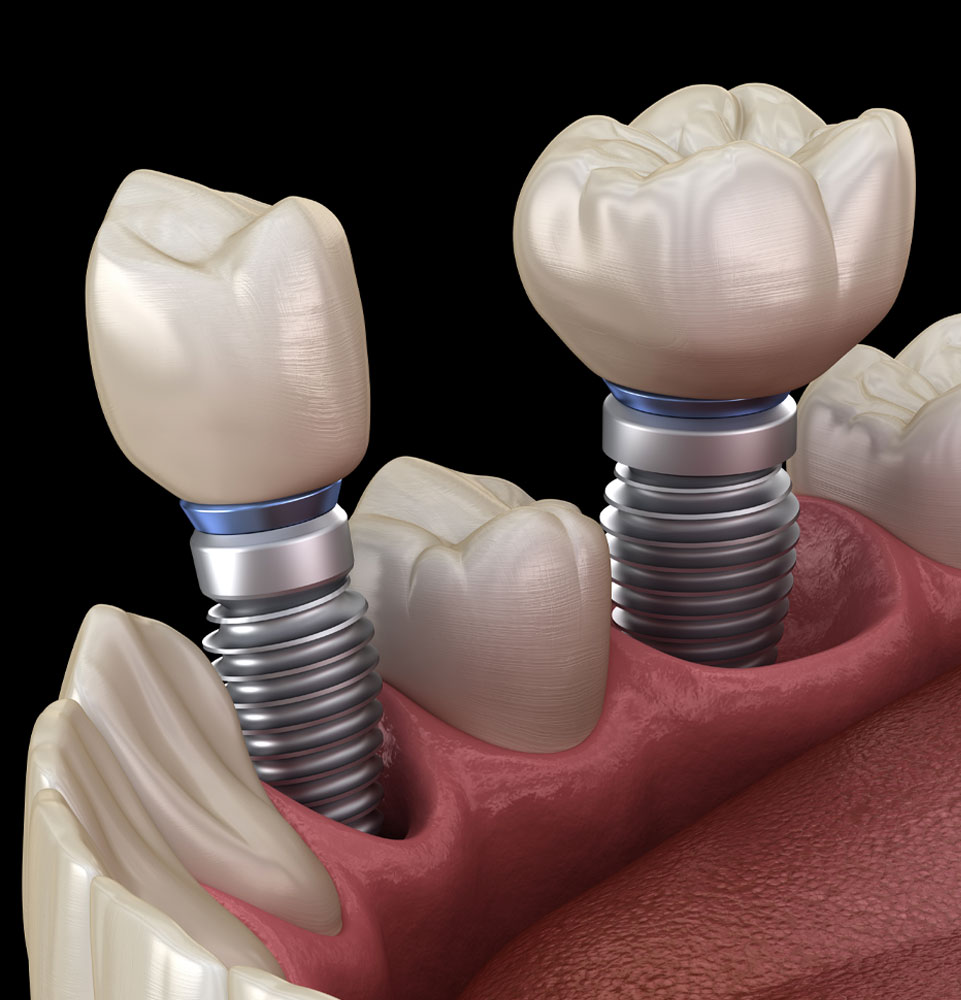 dental implants 3d model
