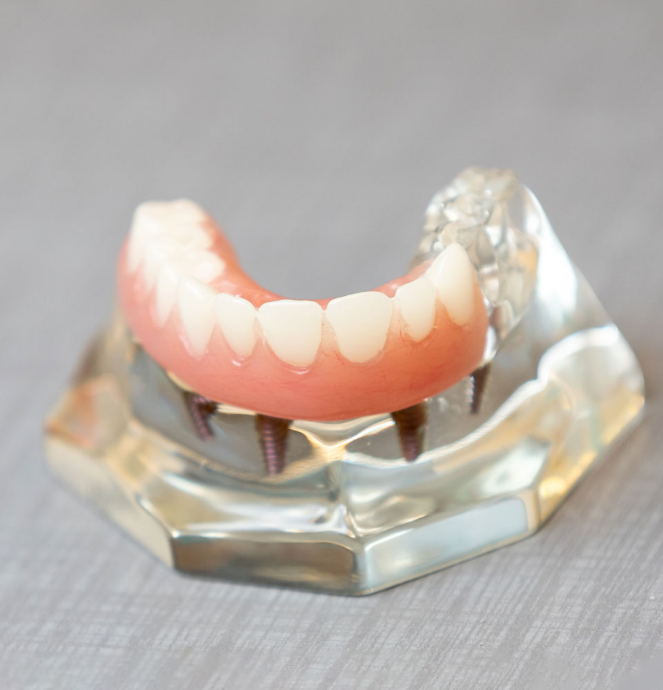full arch physical model at dental practice