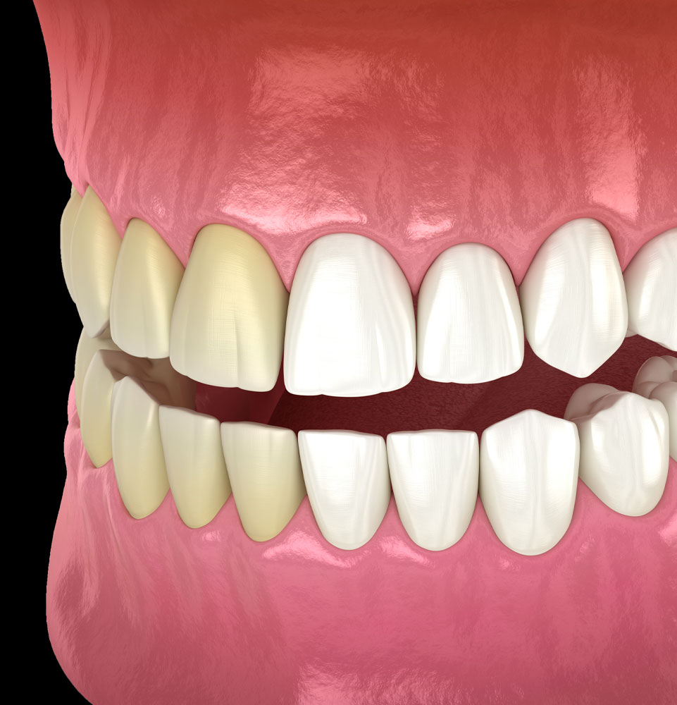 tooth whitening 3d model